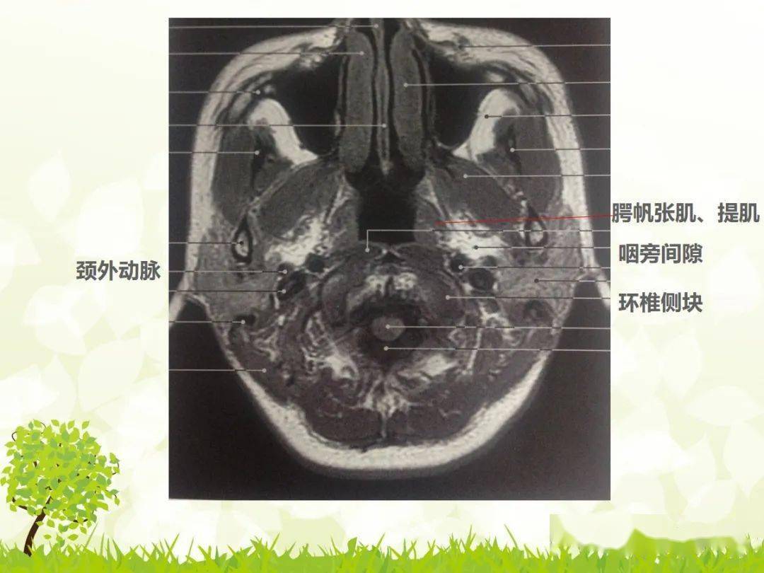 咽旁间隙解剖及常见病变影像表现