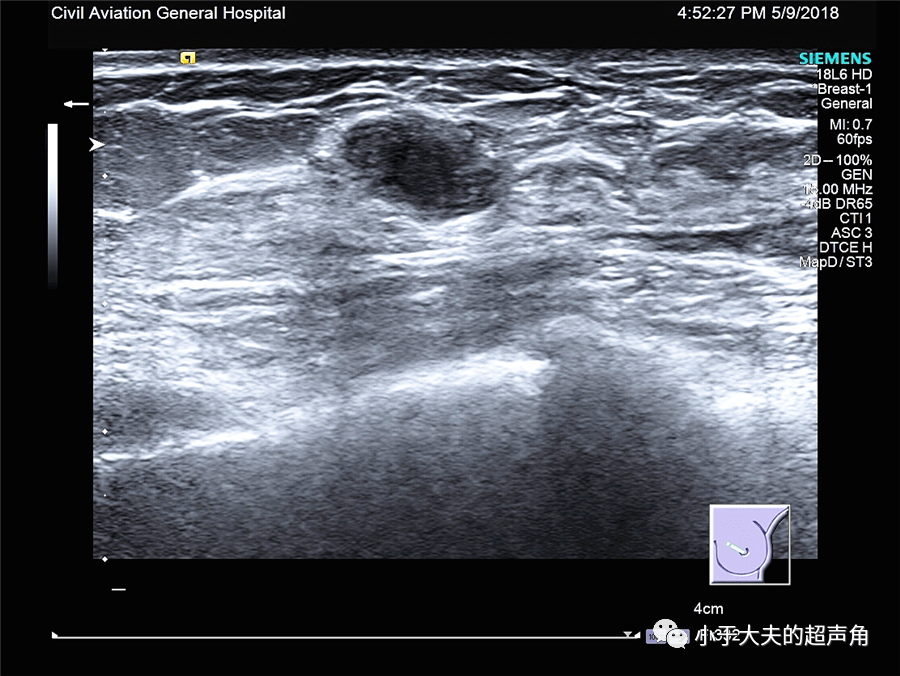乳腺结节b超图片良性图片