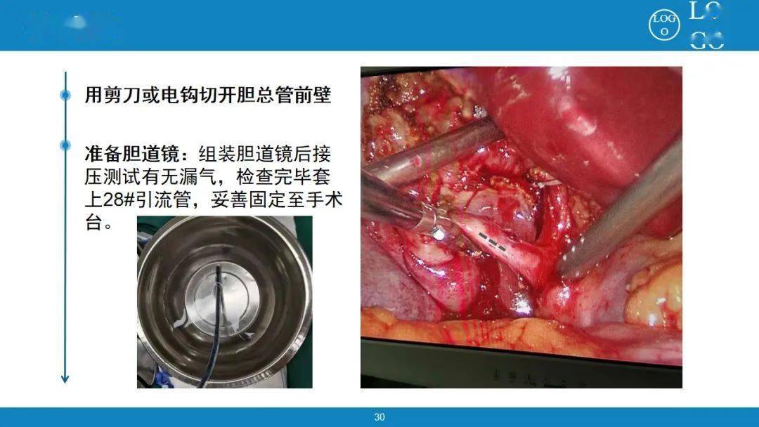 护理查房腹腔镜胆道镜探查