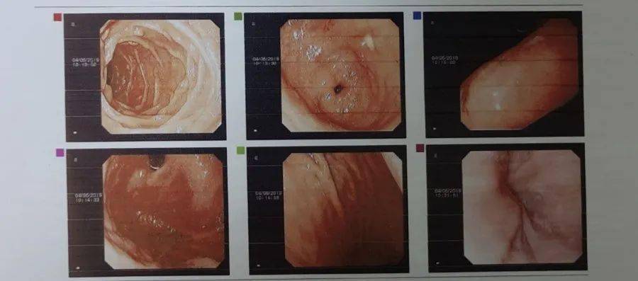 肠镜6张图片对应部位图片