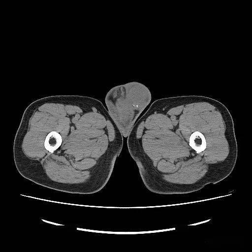 腹股沟炎性包块