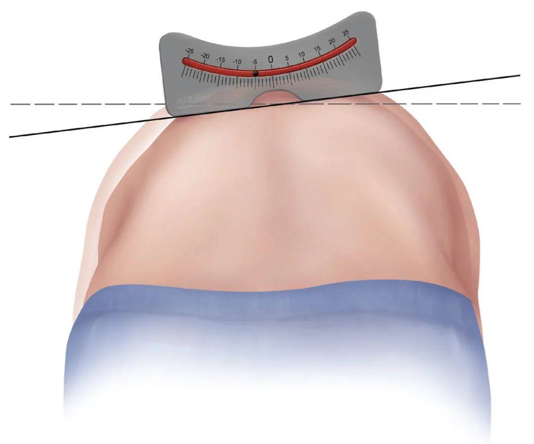 这个病会影响孩子一生,早预防,早发现很重要!