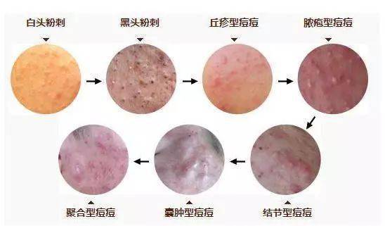 粉刺和痘痘傻傻分不清楚你还想要美丽