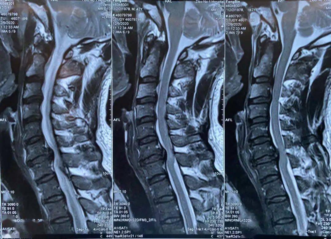 脊髓型颈椎病核磁图片图片