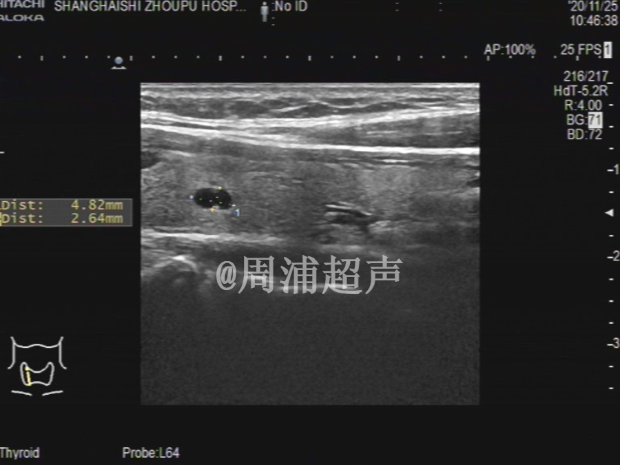 t-rads 2類:囊性結節,包括甲狀腺膠質瀦留囊腫,常規隨訪即可.