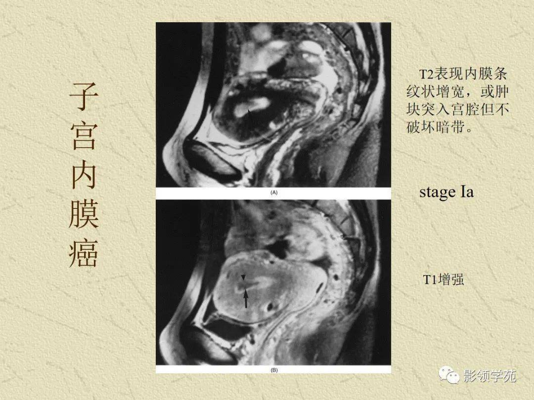 女性盆腔病變的mri診斷