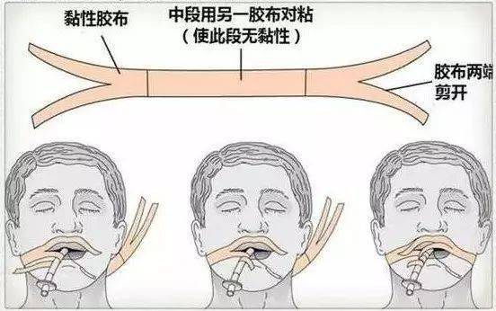 气管插管胶布工字固定图片