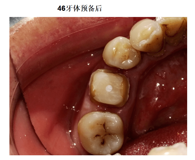 【病例】46重度弯曲根管治疗 纤维桩树脂核 全瓷冠修复