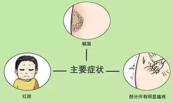 银屑病的分型分期治疗你还不知道怪不得治疗见效不大