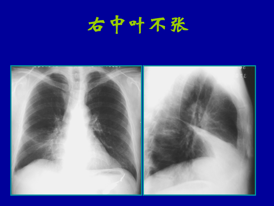 肺部大片陰影影像診斷