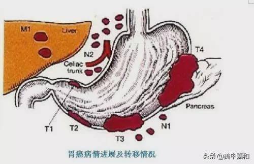 晚期胃癌可能經胸導管轉移至左鎖骨上淋巴結.