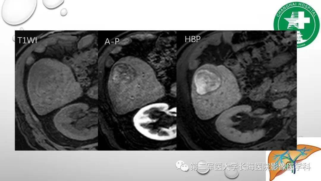 普美显丨肝胆特异性MRI对比剂-钆塞酸二钠Gd-EOB-DTPA-搜狐大视野-搜狐新闻