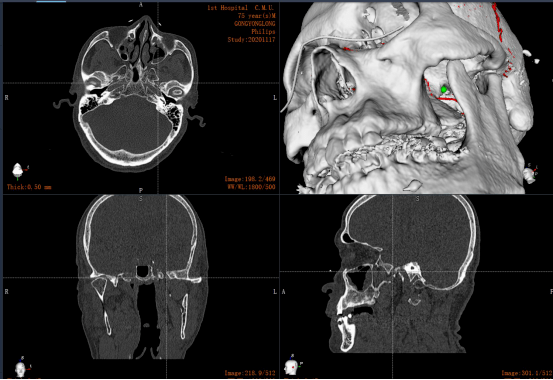 医·术|中国医大一院首次完成机器人辅助三叉神经痛手术
