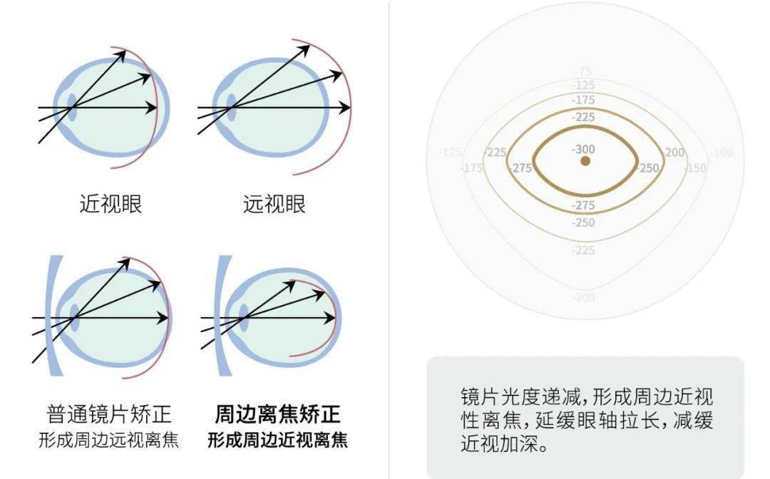 【优立睲视力课堂】震惊!孩子近视,尽然是被绝大部分家长拖出来的