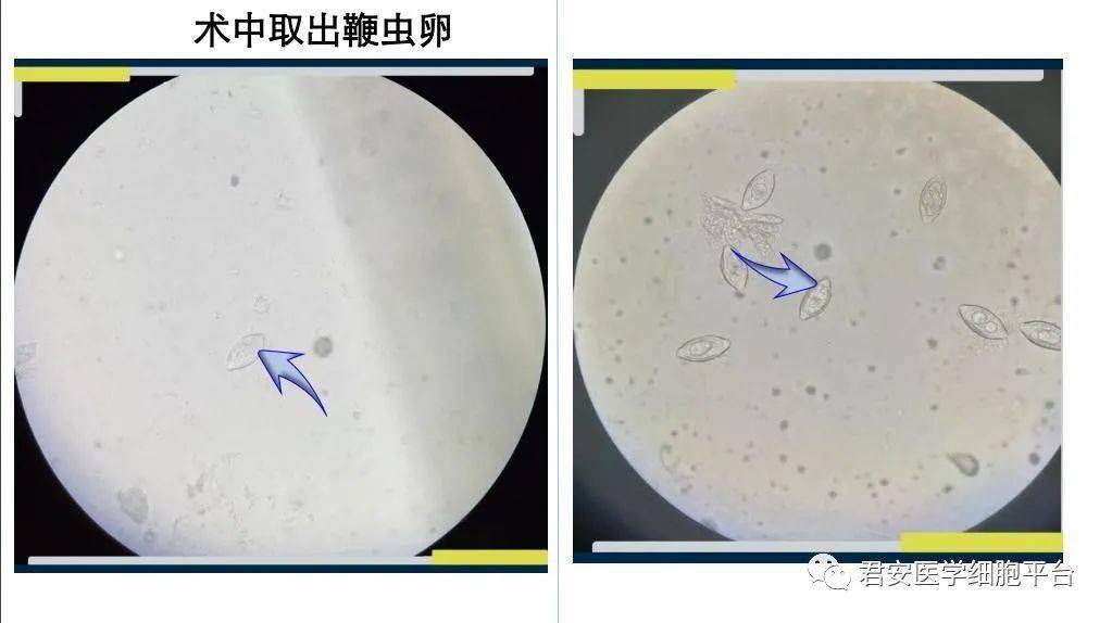 鞭虫卵显微镜下图图片