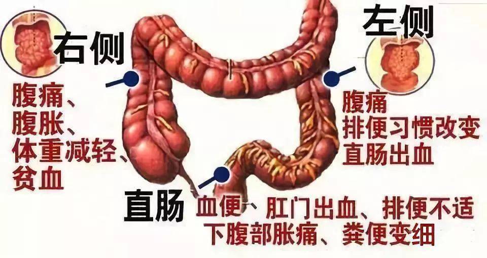 正常大便图肠癌图片