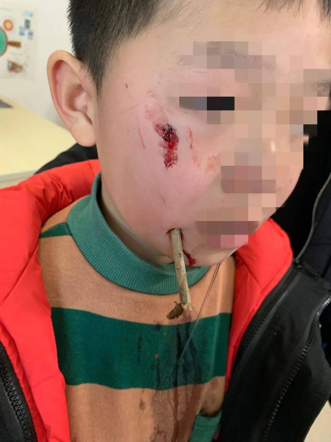 河源10岁男孩面部被树枝刺穿!