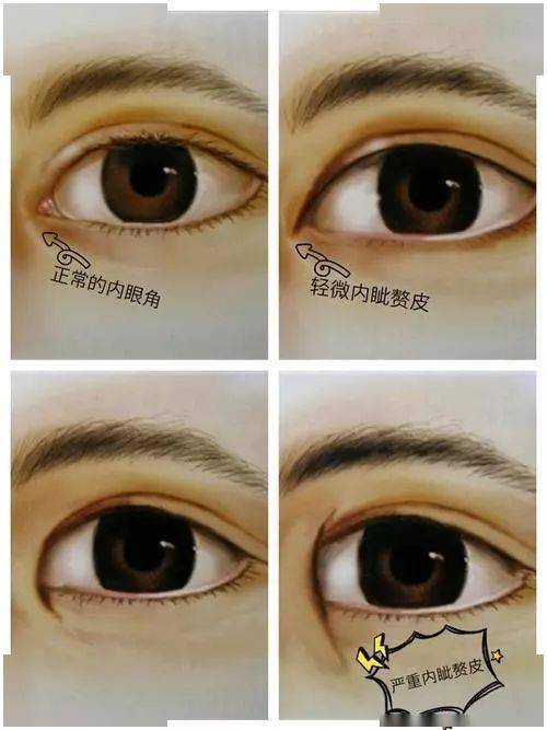 开眼角会眼角变宽吗 202ed5d458c748b69087fb3bc2a94e97.jpeg