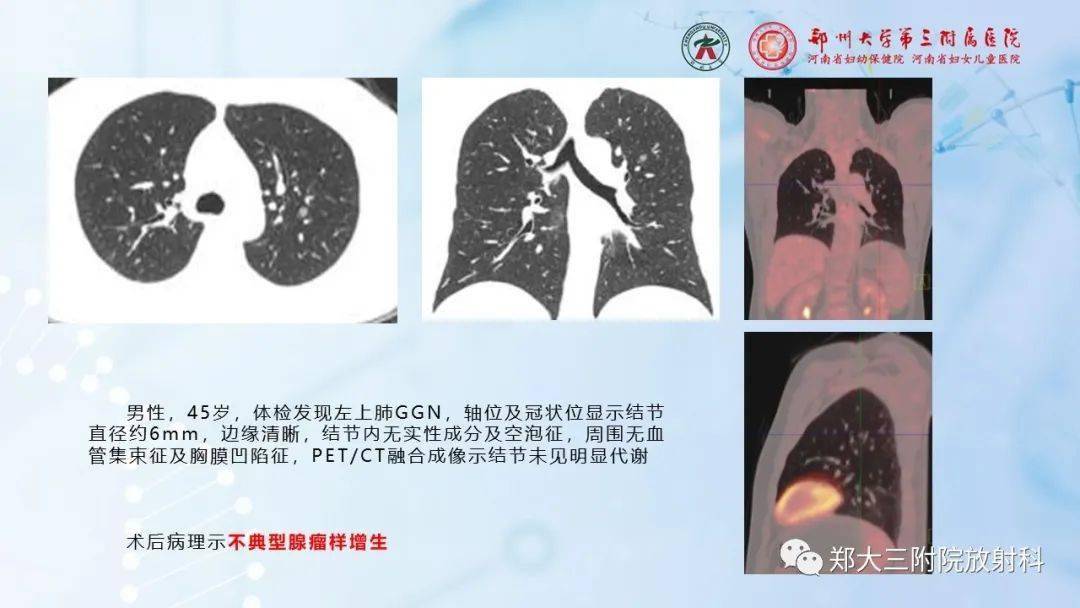 肺结节的前世今生