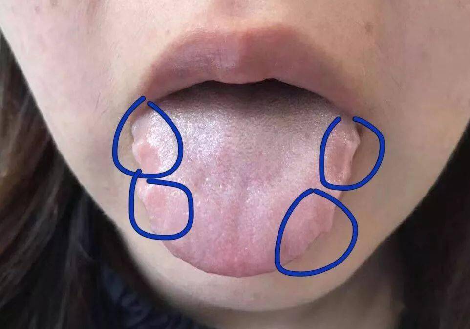 舌头有齿痕代表湿气重?90%的人都吃错红豆薏米了!