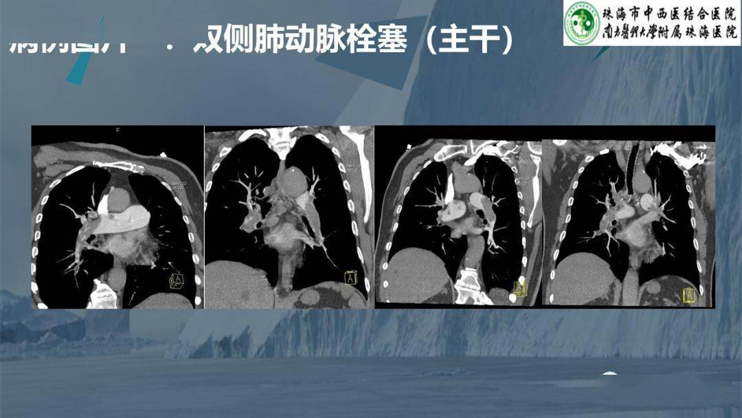 肺动脉cta逐层图解图片