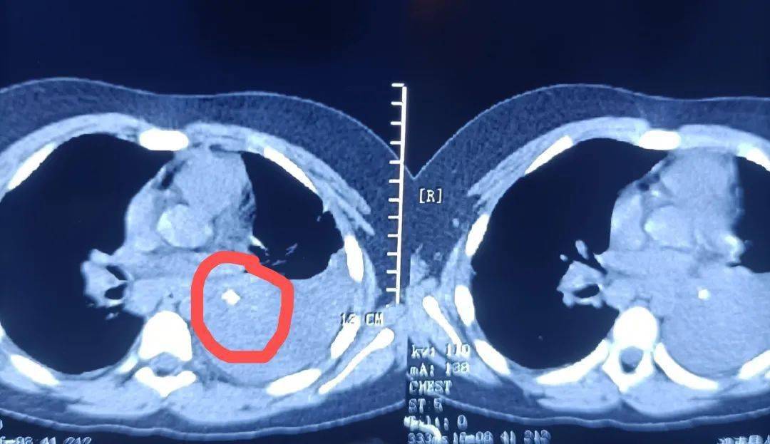 男孩气管卡异物咳嗽一月余医生支气管镜下科学吃鸡