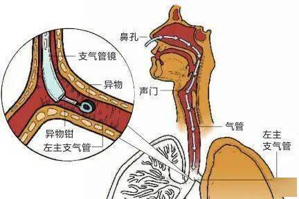 嗆咳,吸氣性呼吸困難,缺氧② 安靜期:異物貼附氣管或支氣管壁時,症狀