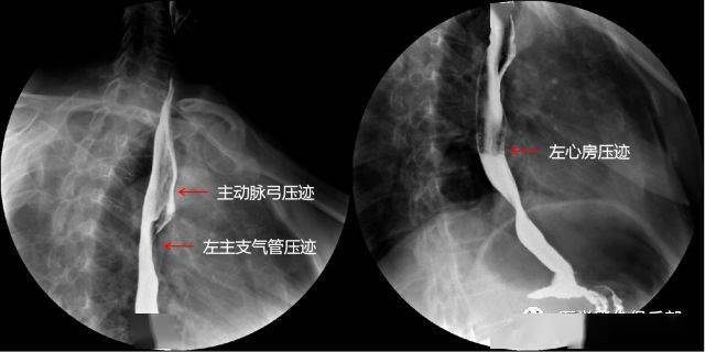 上消化道造影检查技术及常见病变的x线诊断