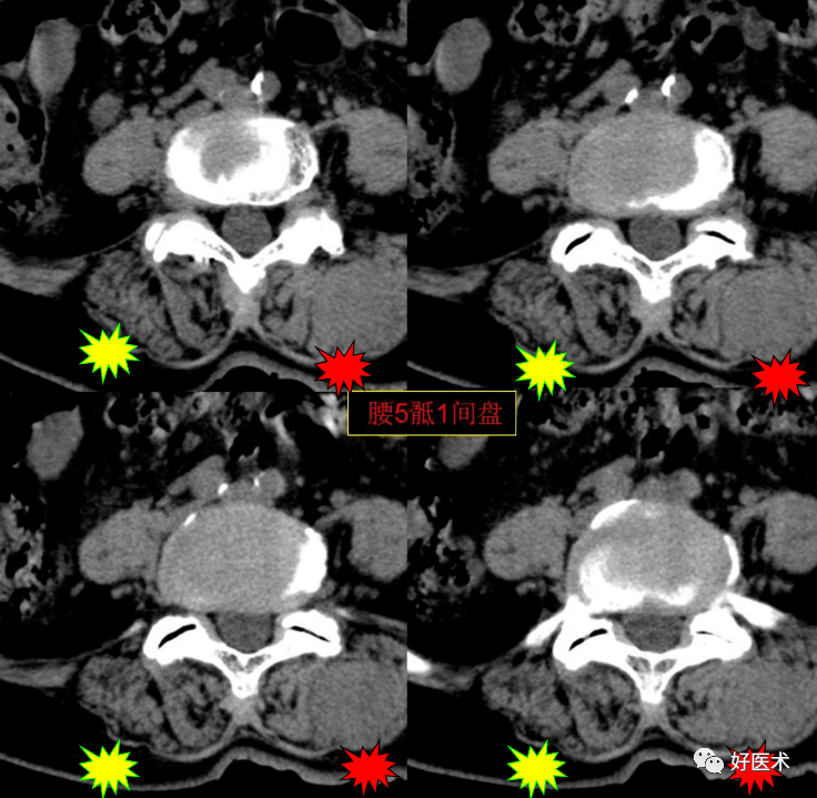 这份看似"无漏洞"的腰部ct,稍不注意将酿成大错!