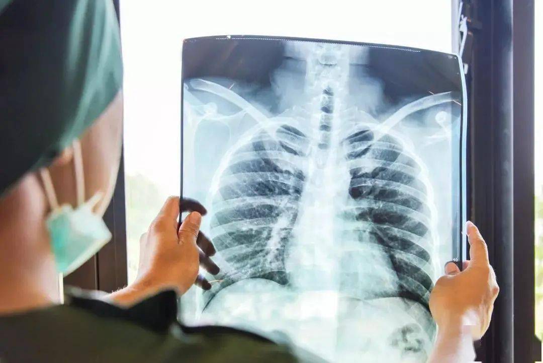 肺结核真实图片 病人图片