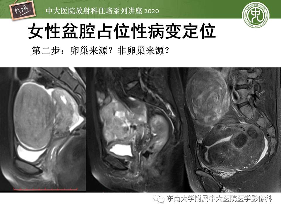 如子宮巨大漿膜下肌瘤,闊韌帶肌瘤;胃腸道來源:位於盆腔腸道來源間質