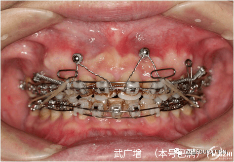 严重深覆合锁合成人矫治案例