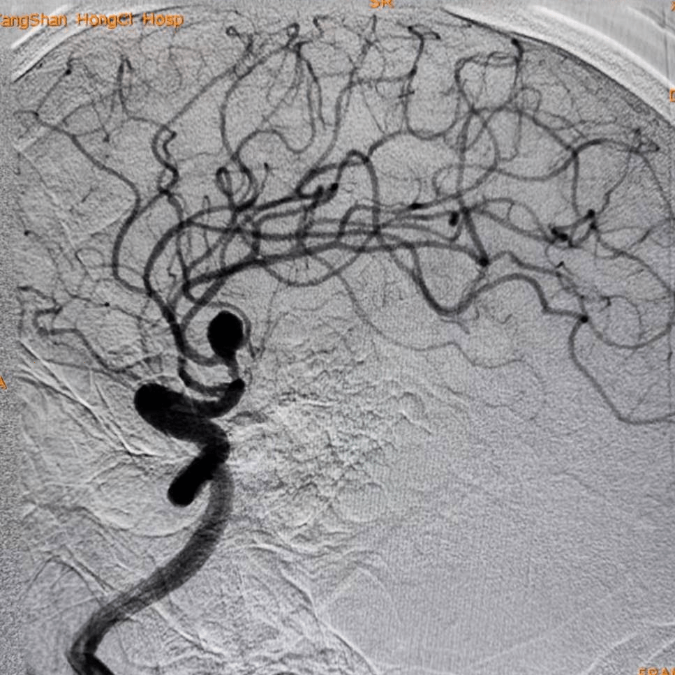 atlas病例集丨徐翔曲径通幽小身材大担当atlas支架在小直径血管内的