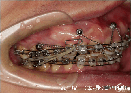 严重深覆合锁合成人矫治案例