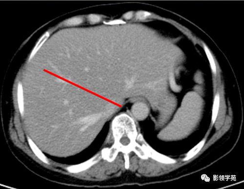 肝脏的表面解剖及分叶分段