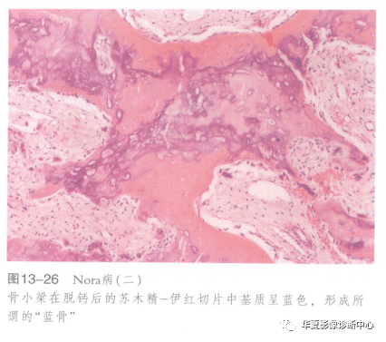 nora病的組織學特徵表現為:①病變由分化成熟的骨,軟骨和纖維三種成分