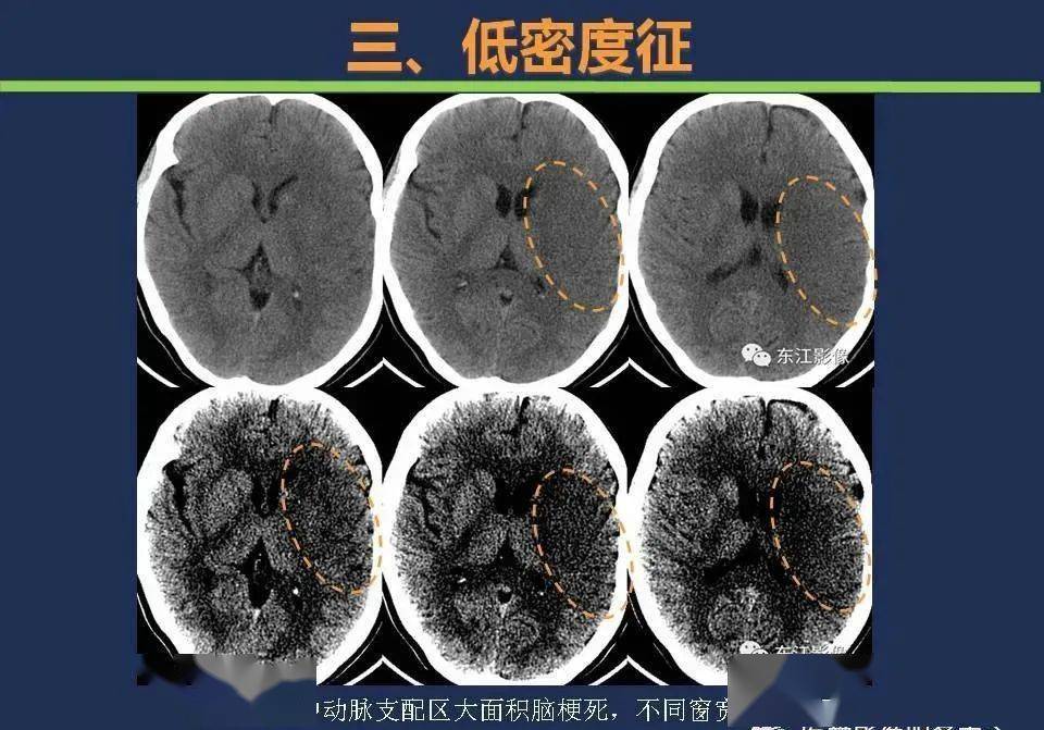 如何根據頭顱ct預判超早期腦梗死