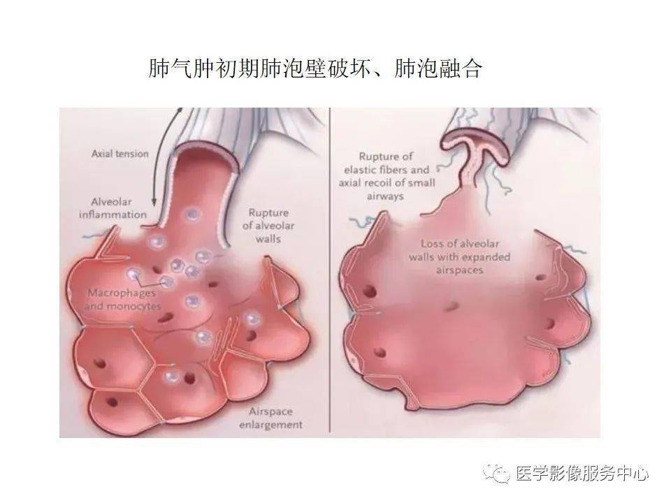 肺气囊:肺部出现大致圆形,薄壁,充满气体的空间.