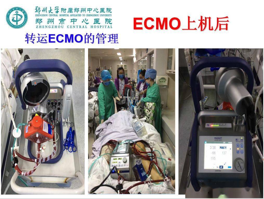 ecmo患者如何护理这几点重点提示你一定要看看