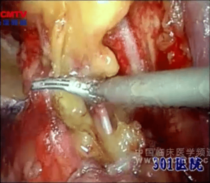 轉載你們要的年度泌尿外科手術視頻榜單top10來啦