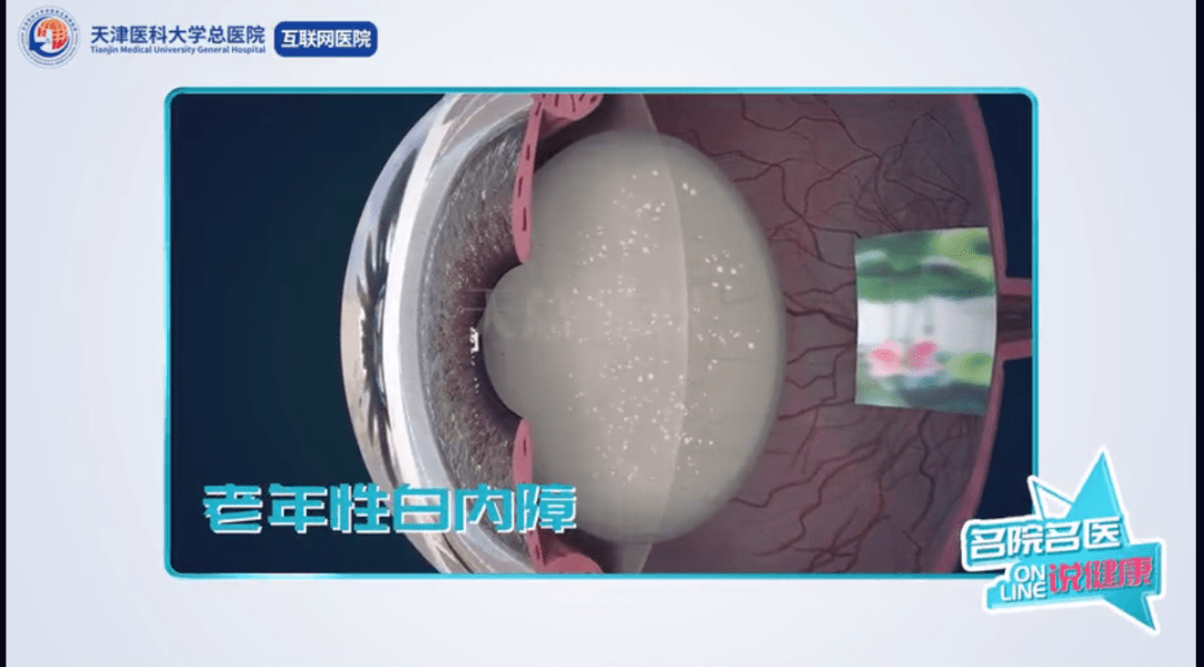 【互聯網醫院·說健康】根除白內障,跟模糊,重影說