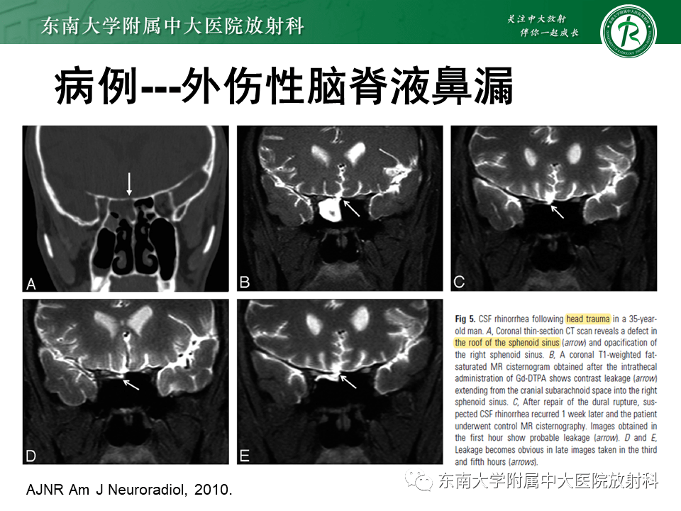 頭頸部病變——腦脊液鼻漏影像學評估