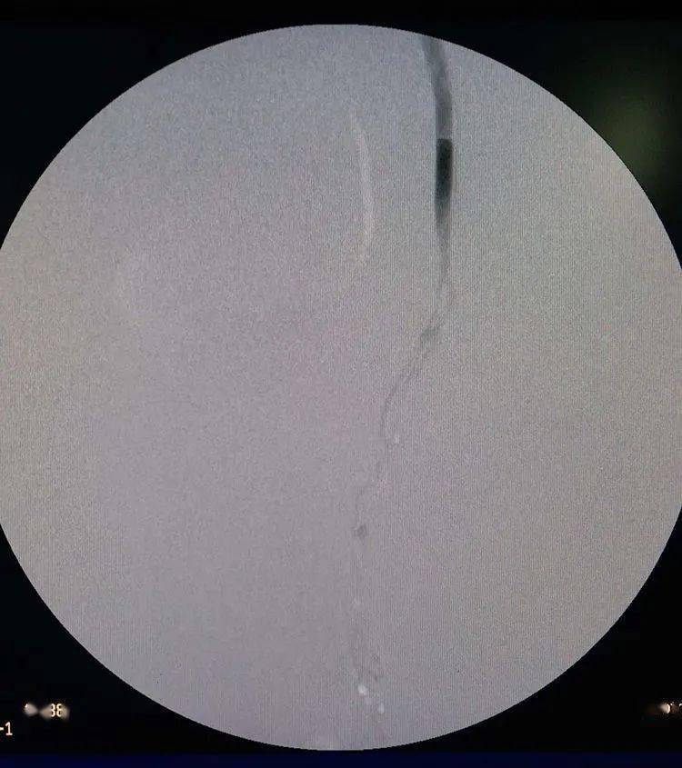 精索静脉曲张泡沫硬化剂栓塞术及术后随访情况