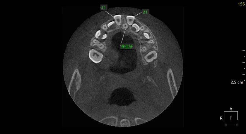王xx 20210128  多生牙cbct 183xxxx1584