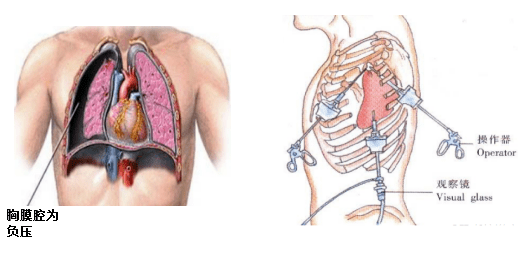 知識更新胸腔鏡手術怎樣才能癟肺更快
