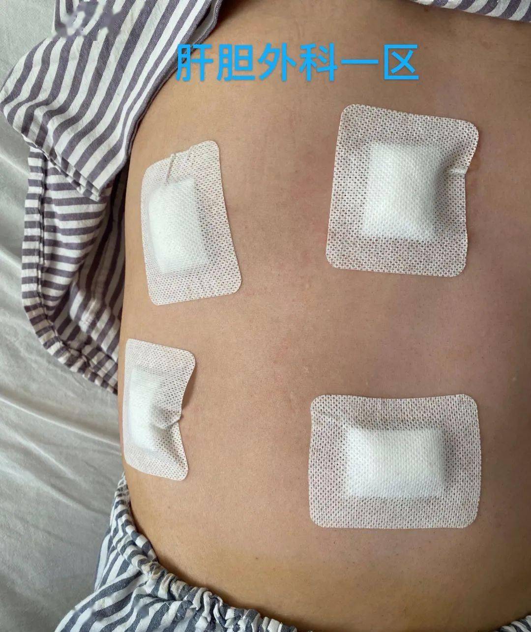 胆囊切除术后六个小时下床活动啦 患者