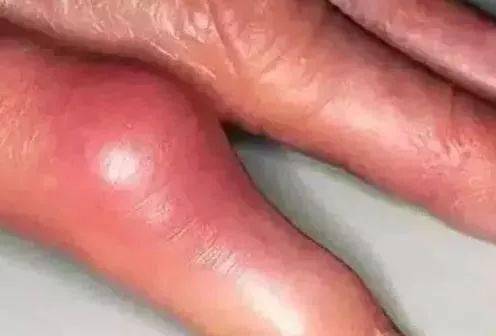 吃什么能化掉血管里的斑块 b7cd6bbd6c5c491a98c59597511acb7f.jpeg