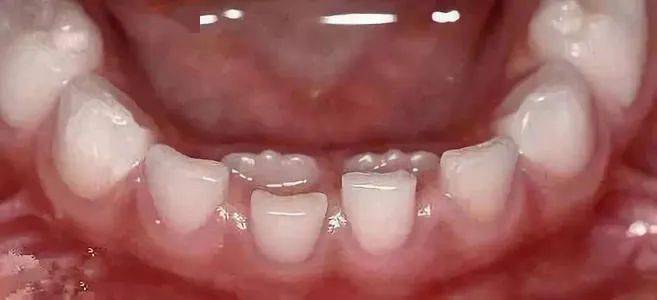儿童替牙期的烦恼门牙变成大板牙是怎么回事