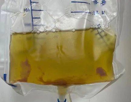 杭州女孩左肺被淹没一半不到40斤的她引流出500ml脓液