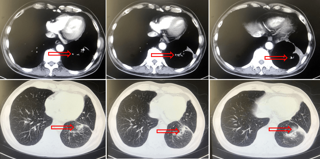 伴脑转移晚期肺癌患者迎来治疗新转机_肿瘤